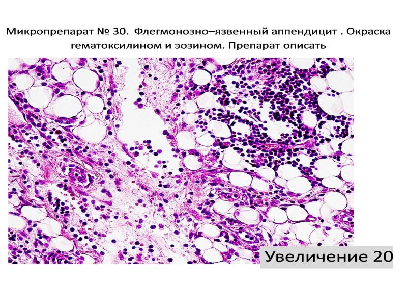 Флегмонозный аппендицит микропрепарат рисунок