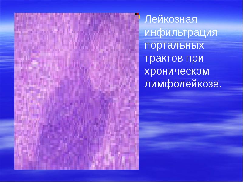 Лейкозная инфильтрация портальных трактов при хроническом лимфолейкозе. Лейкозная инфильтрация портальных трактов