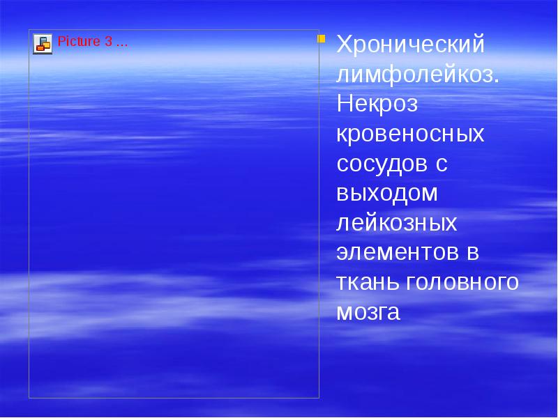 Хронический лимфолейкоз. Некроз кровеносных сосудов с выходом лейкозных элементов в ткань