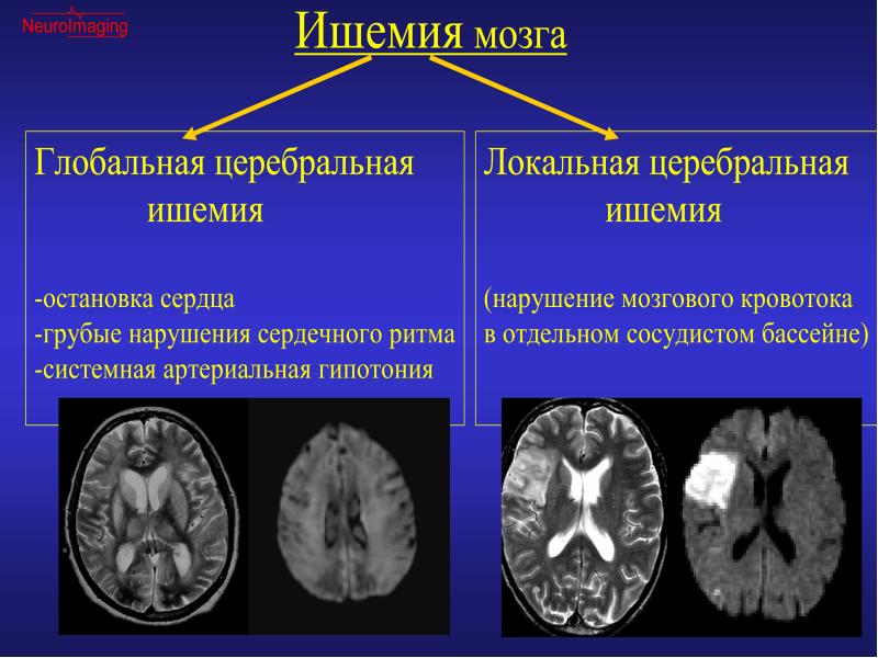 Последствия инфаркта мозга