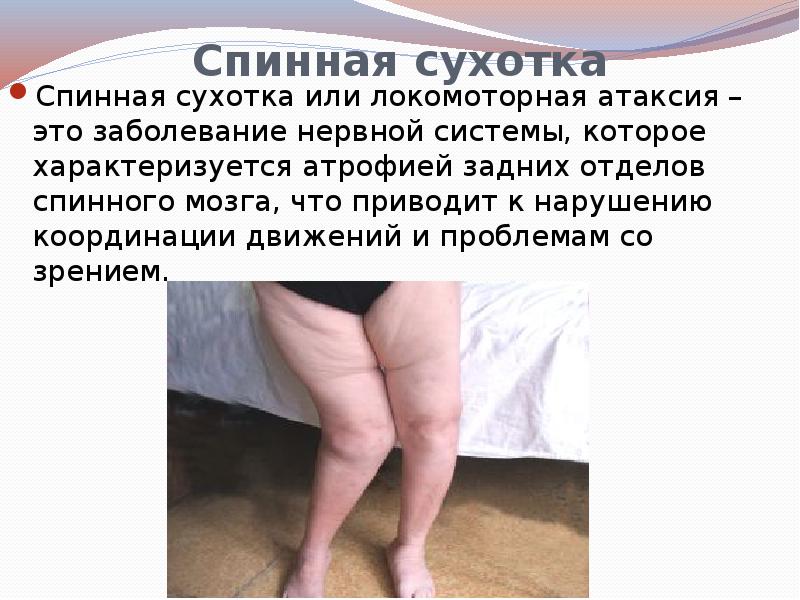 Спинная сухотка
Спинная сухотка или локомоторная атаксия – это заболевание Спинная сухотка
Спинная сухотка или локомоторная атаксия – это заболевание