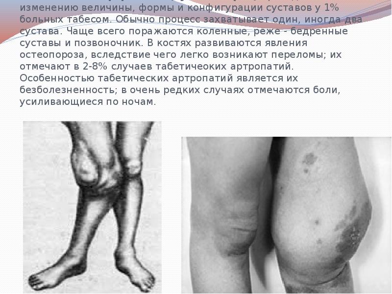 Табетическая артропатия (сустав Шарко) приводит к изменению величины, формы и конфигурации Табетическая артропатия (сустав Шарко) приводит к изменению величины, формы и конфигурации