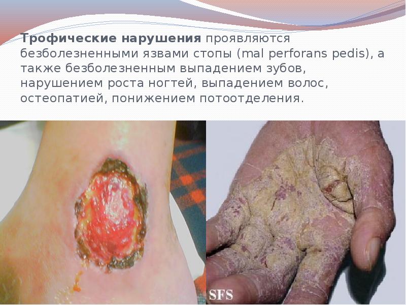 Трофические нарушения проявляются безболезненными язвами стопы (mal perforans pedis), а также Трофические нарушения проявляются безболезненными язвами стопы (mal perforans pedis), а также
