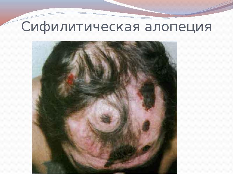 Сифилитическая алопеция Сифилитическая алопеция