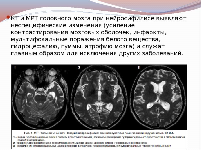 КТ и МРТ головного мозга при нейросифилисе выявляют неспецифические изменения (усиление КТ и МРТ головного мозга при нейросифилисе выявляют неспецифические изменения (усиление