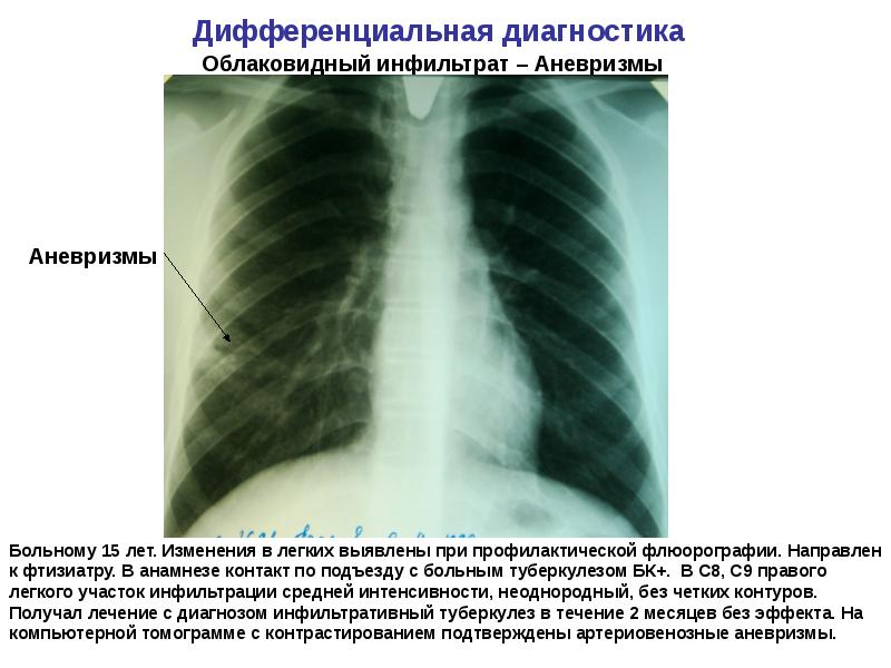 Презентация инфильтративный туберкулез легких