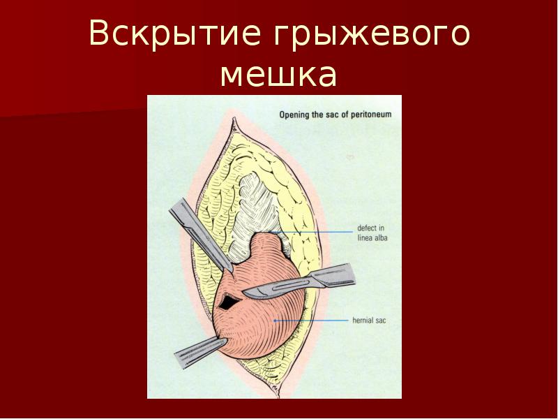 Осложнения грыж. Грыжа сальниковой сумки. Многокамерный грыжевой мешок.