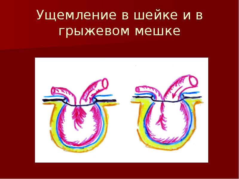 Осложнения грыж. Ущемление грыжи осложнения. Многокамерный грыжевой мешок. Ущемление грыжевого мешка.