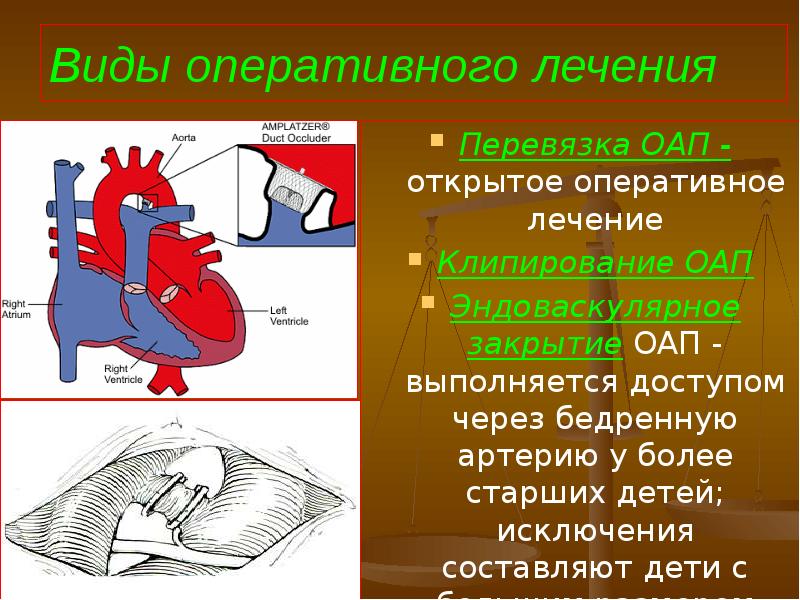 Открытый артериальный проток презентация