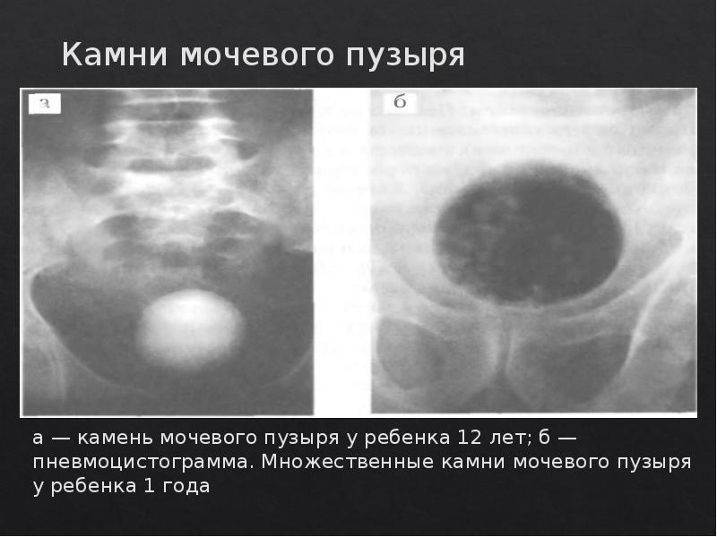 Мочекаменная болезнь урология презентация