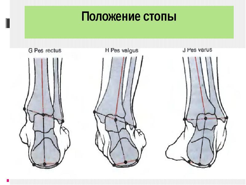 Плоскостопие пронация стопы. Постановка стопы при беге. Постановка на внешнюю сторону стопы. Плоскостопие 1 степени у детей 3 лет. Правильная постановка стопы при ходьбе.