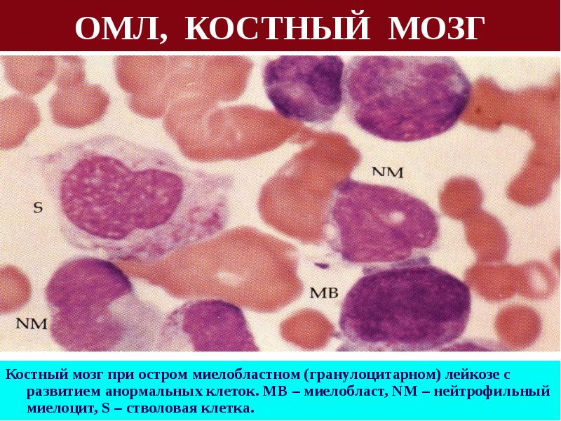 Пересадка костного мозга при лейкозе. Острый миелобластный лейкоз бласты. Острый лимфобластный лейкоз костный мозг. Острый лимфобластный лейкоз исследования костного мозга. Острый миелобластный лейкоз патофизиология.