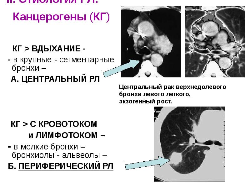 Рак легкого презентация