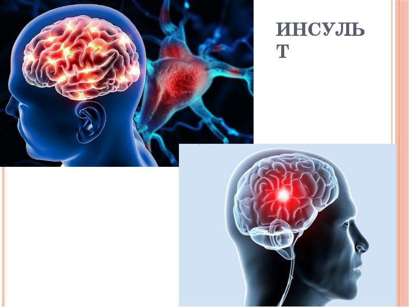 Инсульт левой стороны головного мозга прогноз. Инсульт. инсульт картинки.