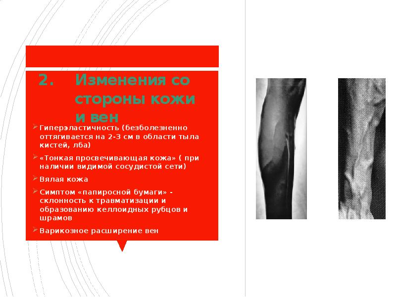 Изменения со стороны кожи и вен Гиперэластичность (безболезненно оттягивается на 2-3