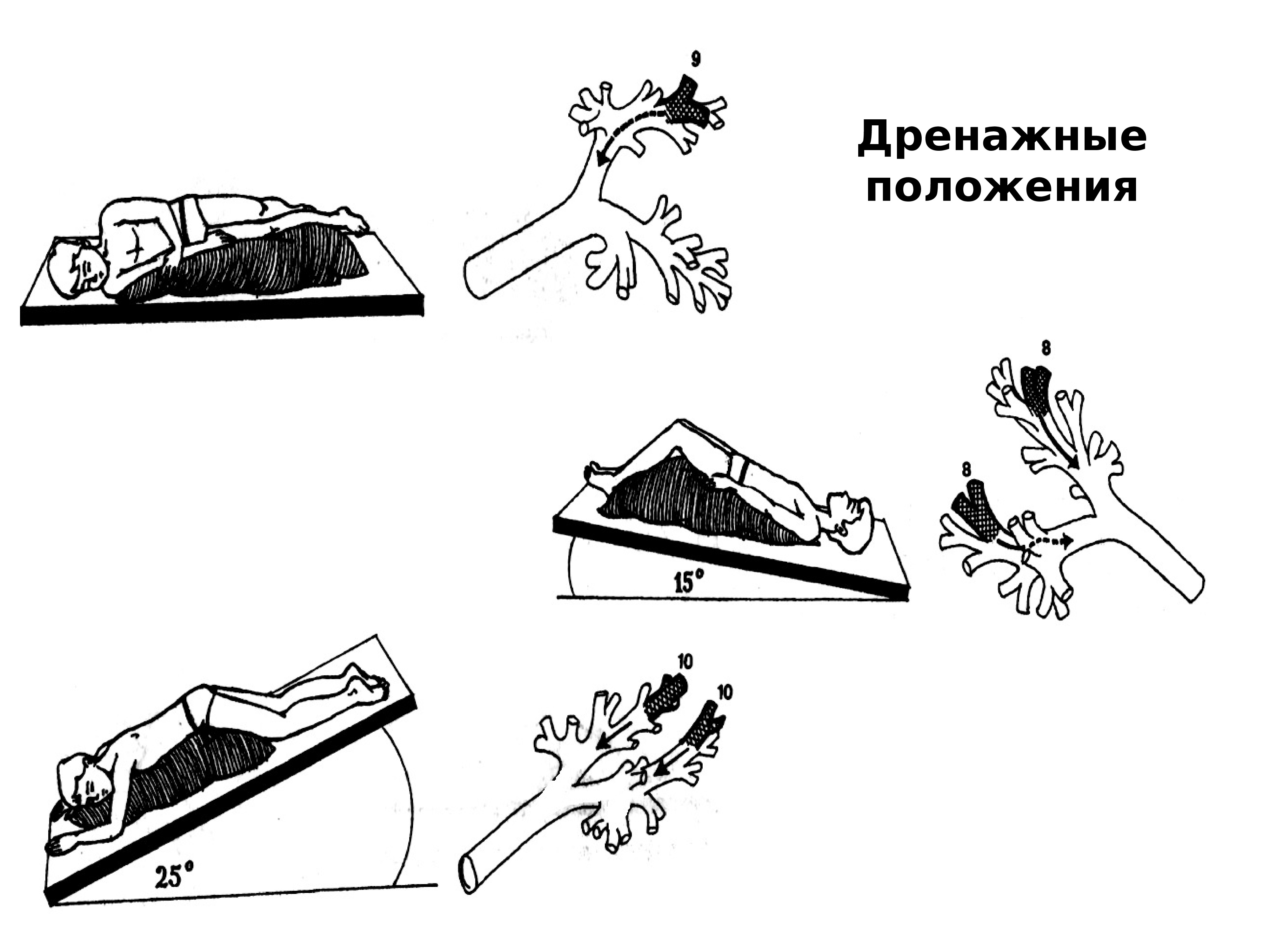 Дренажное положение. Постуральный дренаж положение Квинке. Положение Квинке для отхождения мокроты. Положение Квинке это дренажное положение. Дренаж для отхождения мокроты.