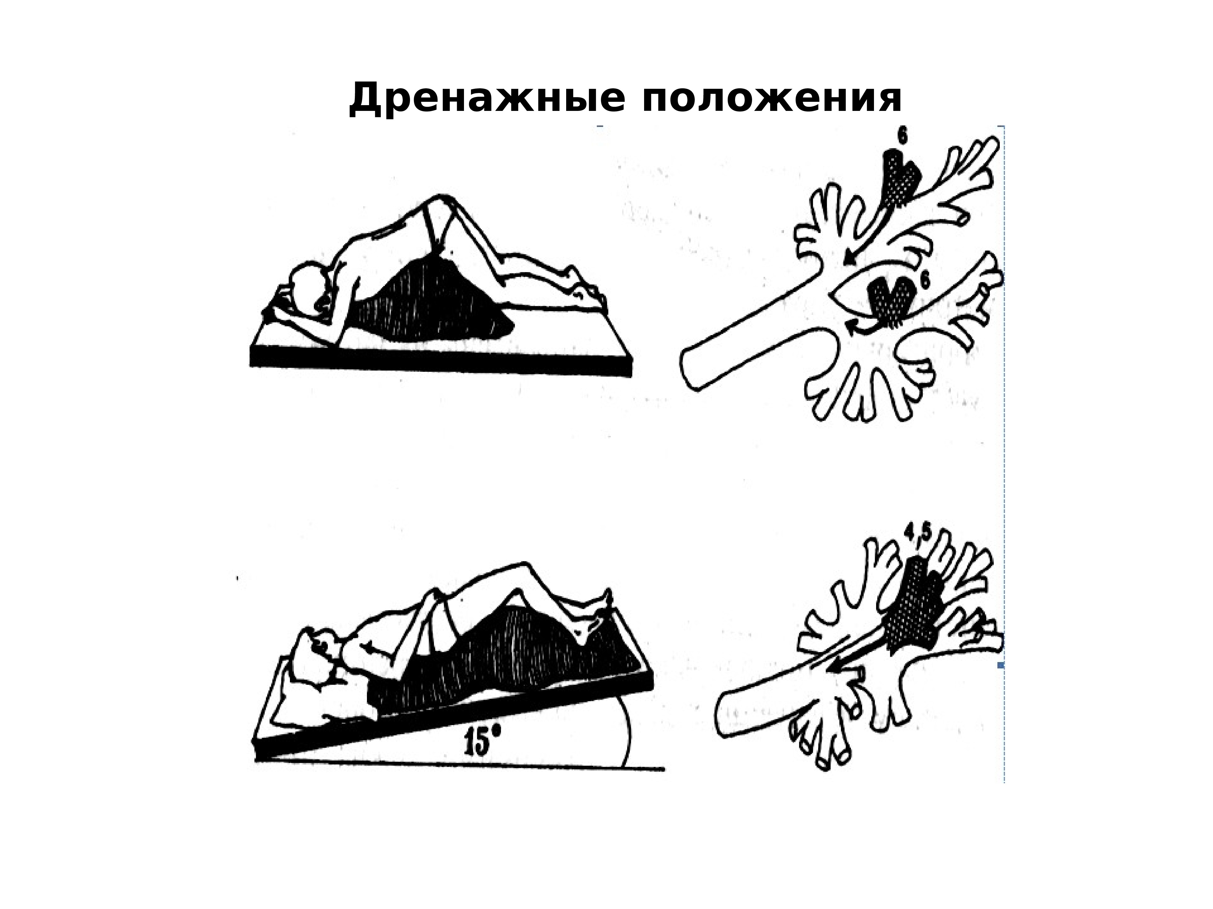 Постуральный дренаж картинка