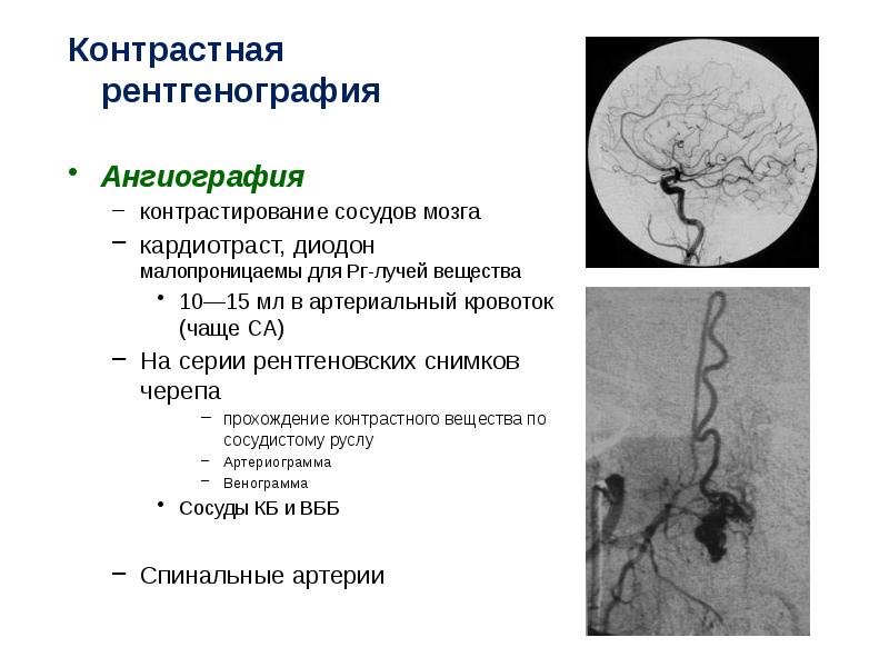 Ангиография сосудов головного мозга презентация