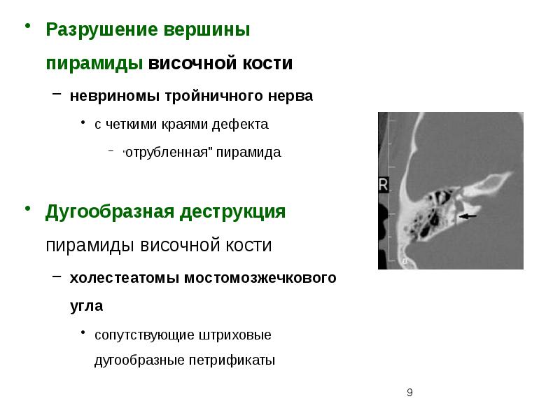 Пирамиды височной. Деструкция пирамиды височной кости. Деструкция ячеек пирамиды височной кости. Вершина пирамиды височной кости. Разрушение вершины пирамиды височной кости с четкими краями дефекта.