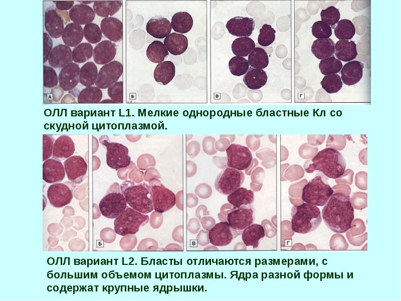 Бласты. Бласты и Циты. Острый лимфобластный лейкоз у животных. Бластные клетки с положительной реакцией на полисахариды.