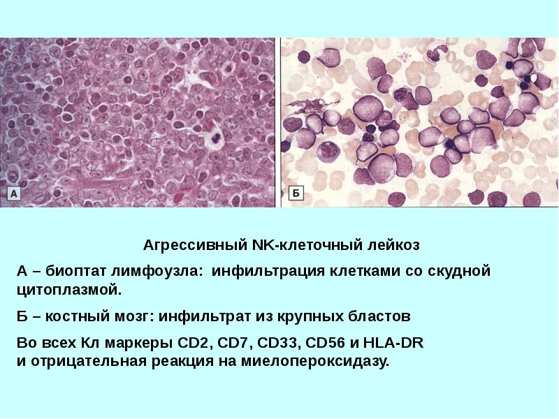 Острый лимфолейкоз презентация