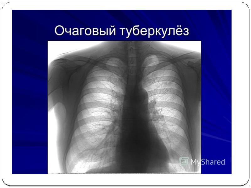 Ошақты туберкулез презентация