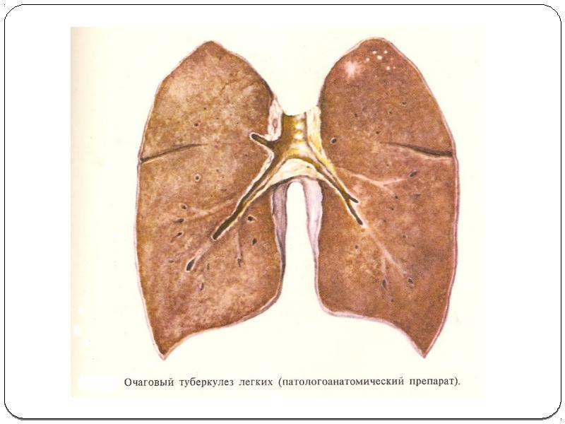 Презентация очаговый туберкулез легких