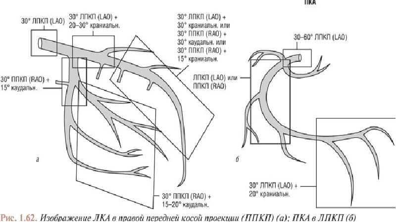 Пна. Сегменты коронарных артерий схема. Правая коронарная артерия проксимальный сегмент. Дистальный сегмент правой коронарной артерии. Проксимальный сегмент ПКА.