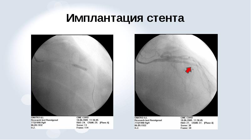 Рентгенэндоваскулярная диагностика презентация