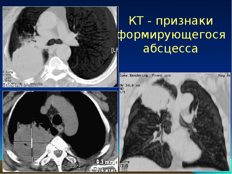 Острая деструктивная пневмония у детей презентация