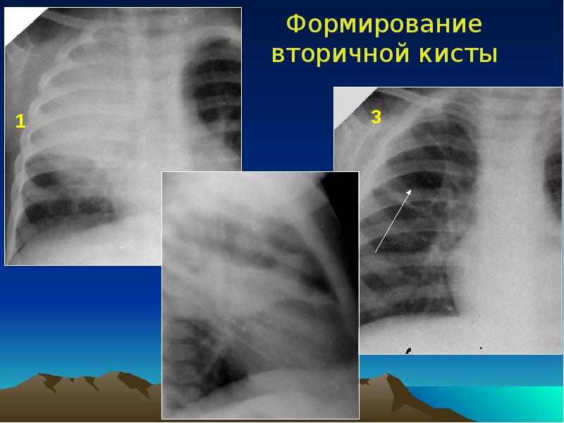 Острая гнойная деструктивная пневмония у детей презентация