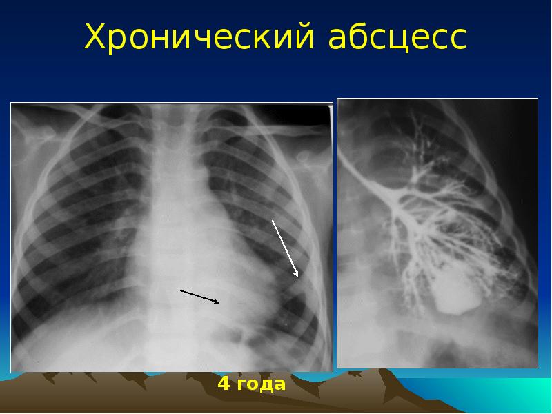 Острая гнойная деструктивная пневмония у детей презентация