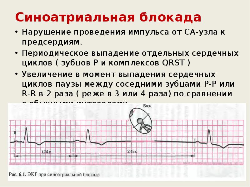 Синоатриальная блокада