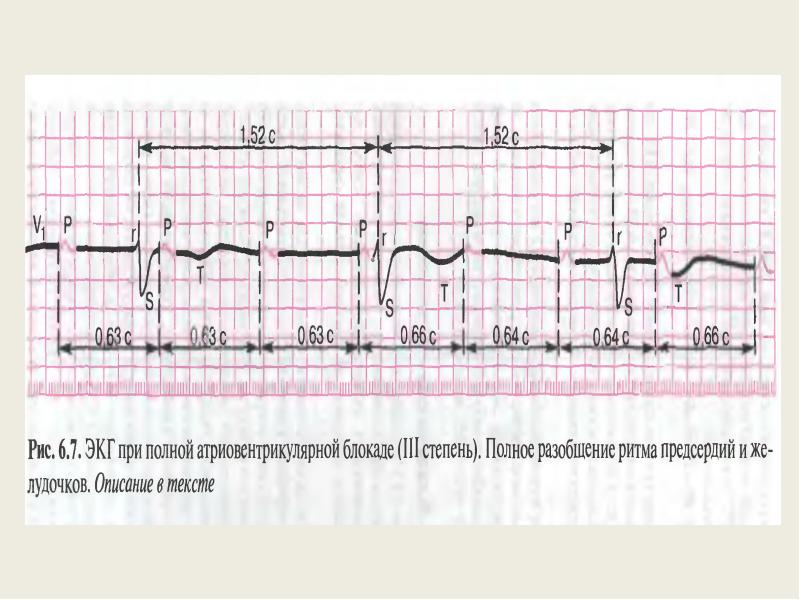 Атриовентрикулярная блокада 3 степени клиника. АВ блокада 3 степени мкб. АВ блокада 3 степени у беременных. АВ блокада клиника.
