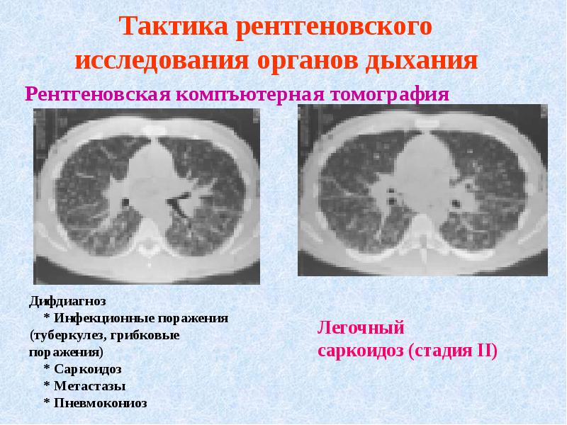 Методы лучевой диагностики органов дыхания презентация