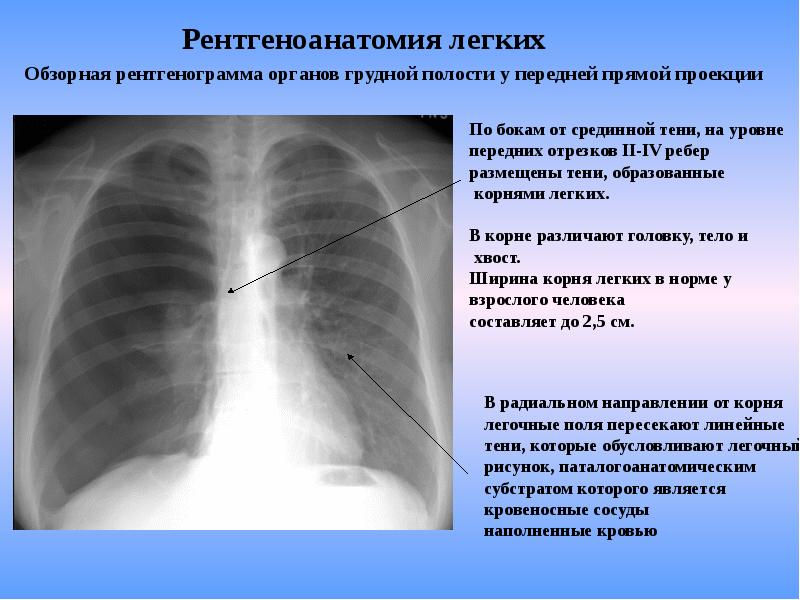 Пневмоторакс лучевая диагностика презентация