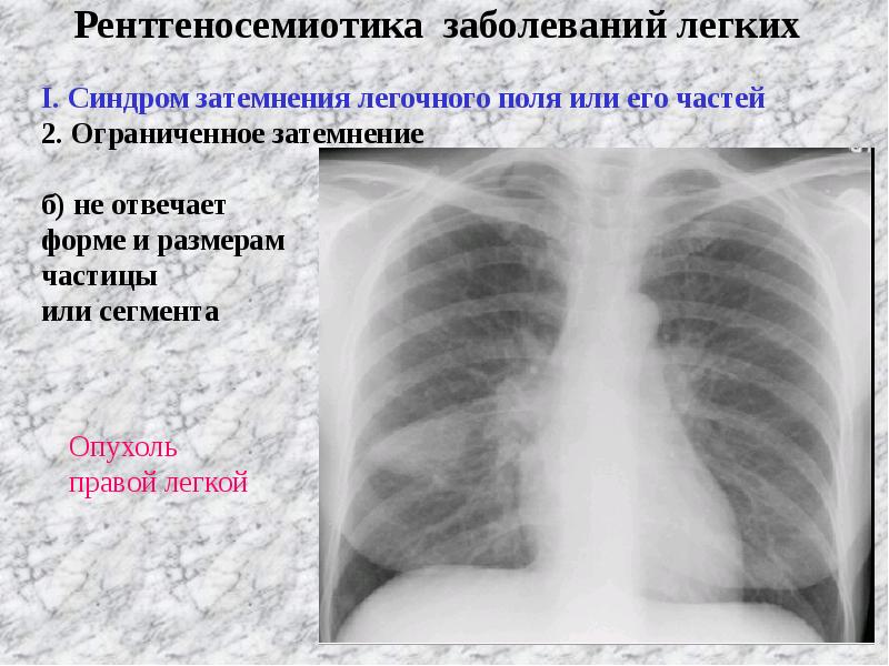 Лучевая диагностика органов дыхания презентация