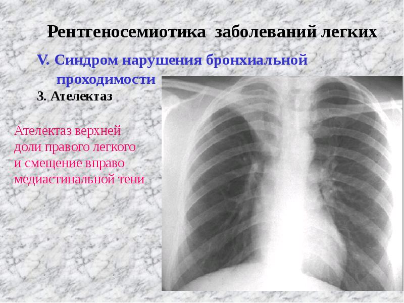 Лучевая диагностика заболеваний легких презентация