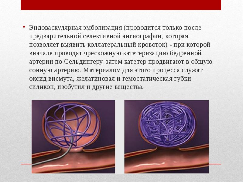 Эмболизация форум. Эндоваскулярная эмболизация. эндоваскулярная эмболизация яичниковых вен. селективная ангиография по сельдингеру.