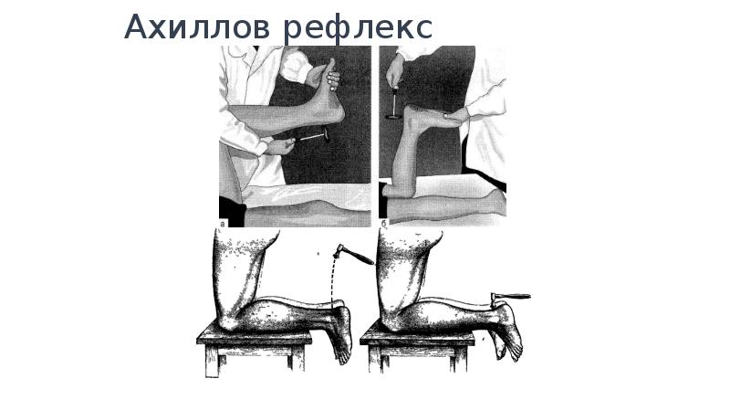 Схема ахиллова рефлекса с указанием звеньев