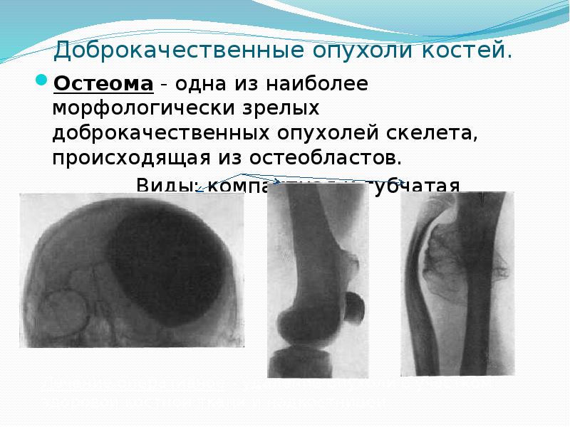 Опухоли костей. Доброкачественные опухоли костей. Доброкачественные костные опухоли. Доброкачественные новообразования костей. Первичные опухоли костей доброкачественные.