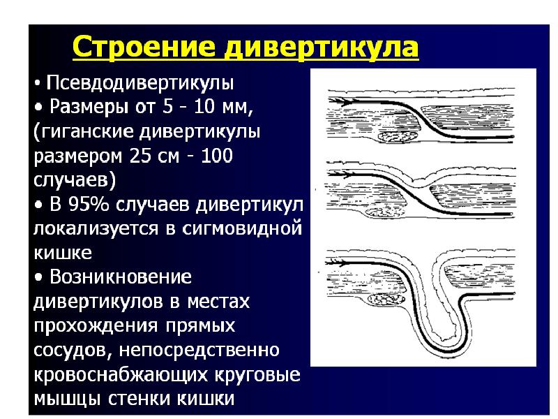 Симптомы дивертикулита. Дивертикулез кишечника гистология. Строение дивертикула кишечника.