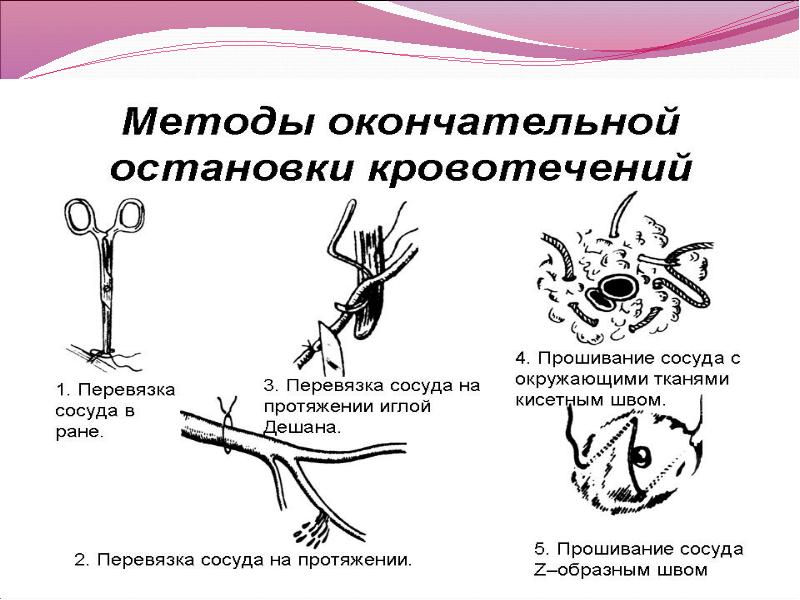 Методы остановки кровотечения презентация