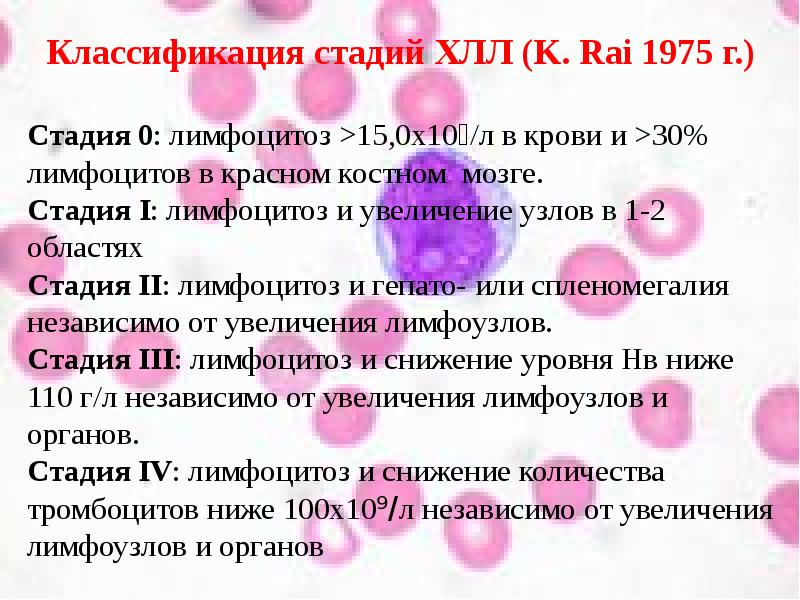 Стадии лимфолейкоза. Стадии хронического лимфолейкоза (классификация по Rai и Binet). Стадии хронического лимфолейкоза. Хронический лимфолейкоз классификация. Классификация стадий хронического лимфолейкоза.