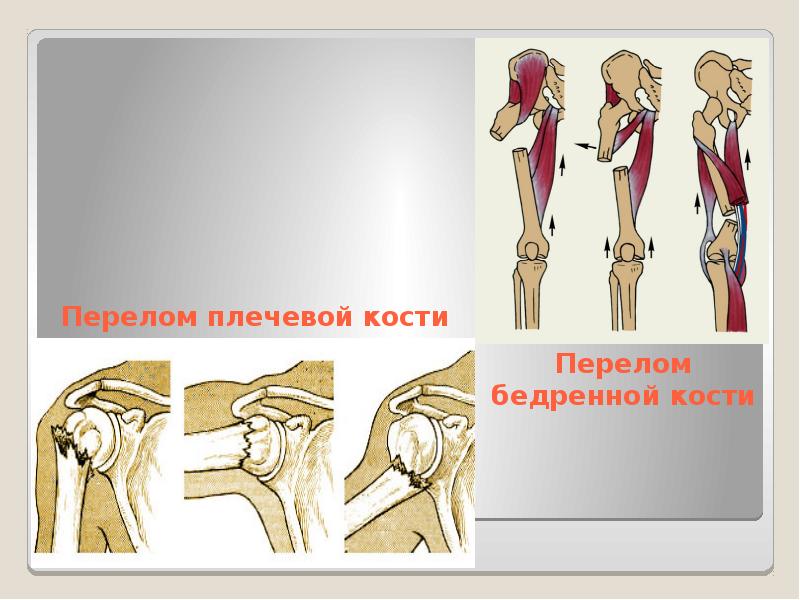 Переломы обж 7 класс презентация