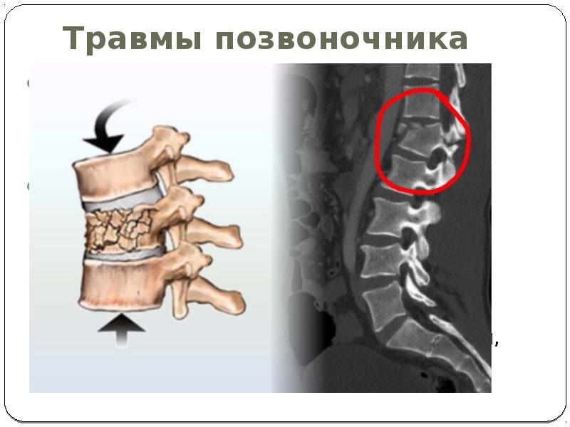 Перелом грудного отдела позвоночника. Компрессионный перелом позвонков l3 l4. Компрессионный перелом l4 l5. Оскольчато компрессионный перелом позвоночника. Осколочный компрессионный перелом l3 позвонка.