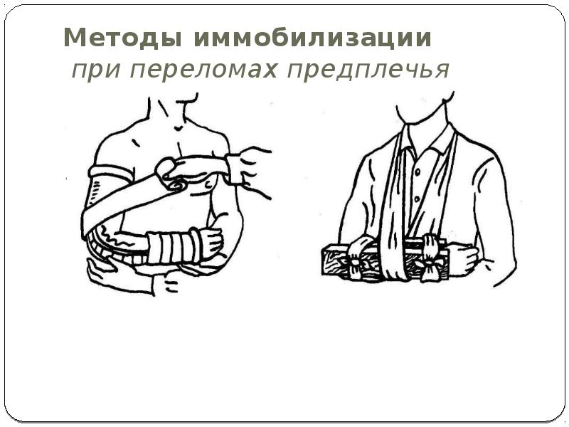 Иммобилизация при переломе. Перелома костей правого предплечья в н/3 транспортная иммобилизация. Иммобилизация конечности при переломе костей предплечья. Технология транспортной иммобилизации при переломах предплечья. Иммобилизация предплечья алгоритм.