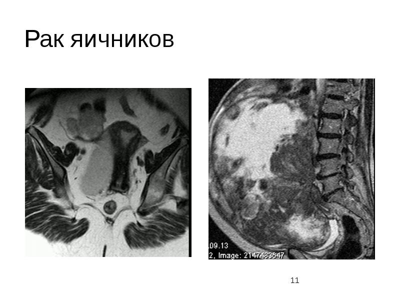 Как выглядит рак яичника
