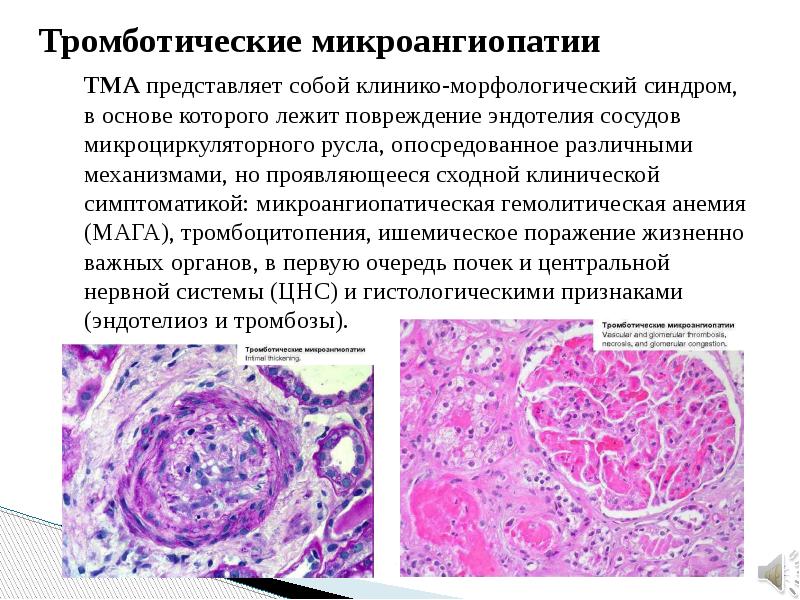 Картина церебральной микроангиопатии