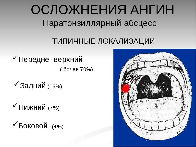 Атипичные формы ангины презентация